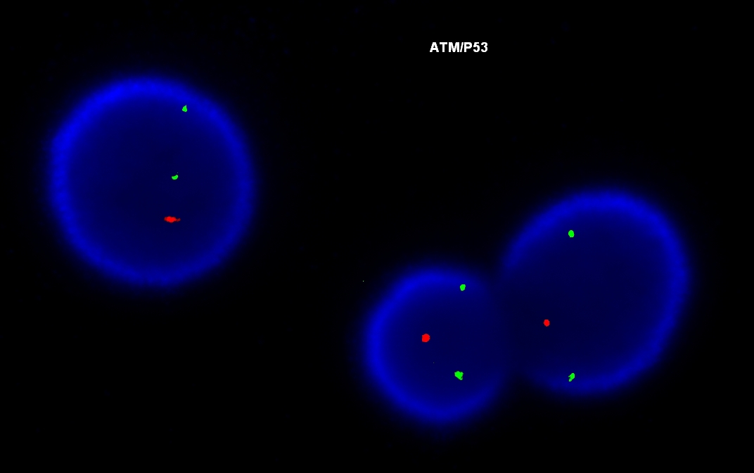 Fish, deletion of chromosome 17 (TP53)